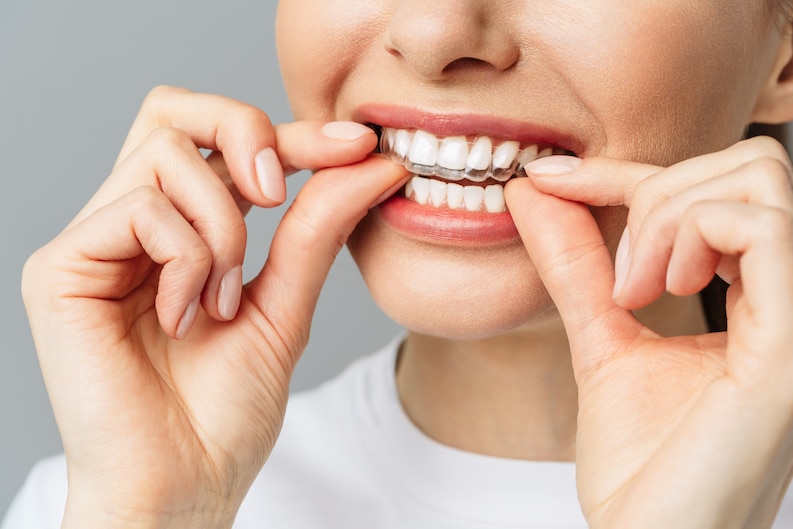 Invisalign treatment In Parel, Mumbai