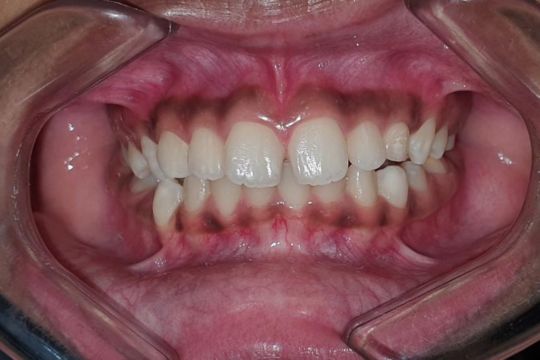 Braces before treatment