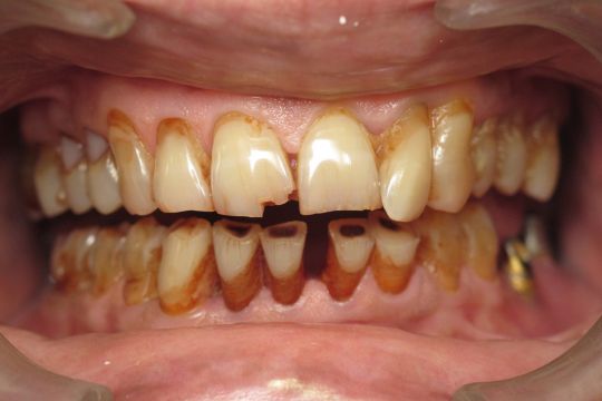 Full Mouth Rehabilitation before and after