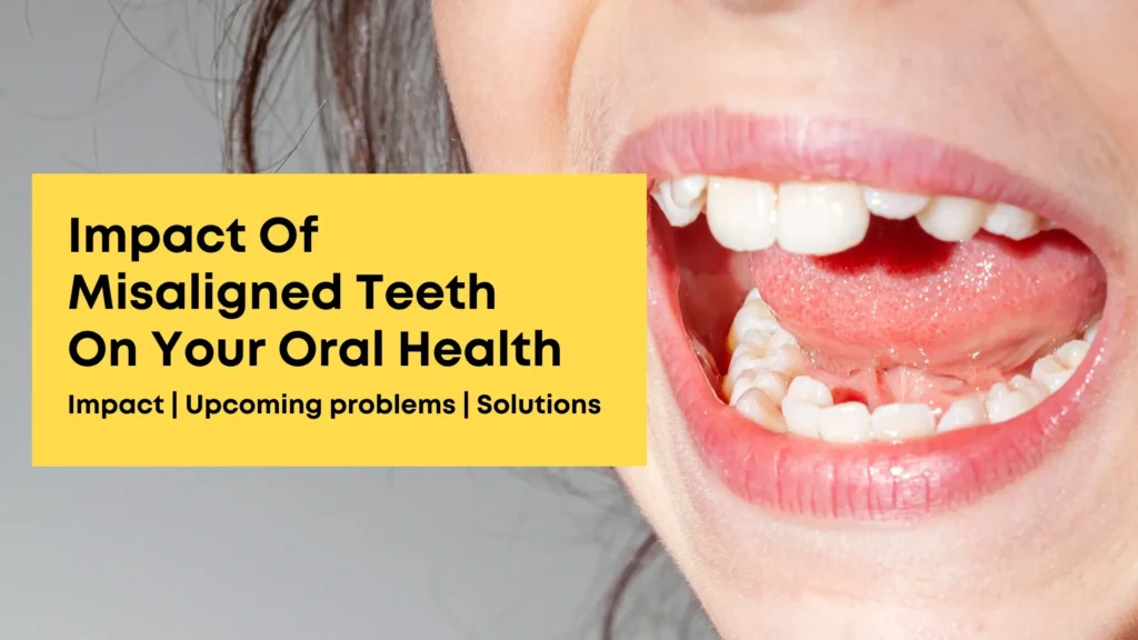 Impact Of Misaligned Teeth On Your Oral Health