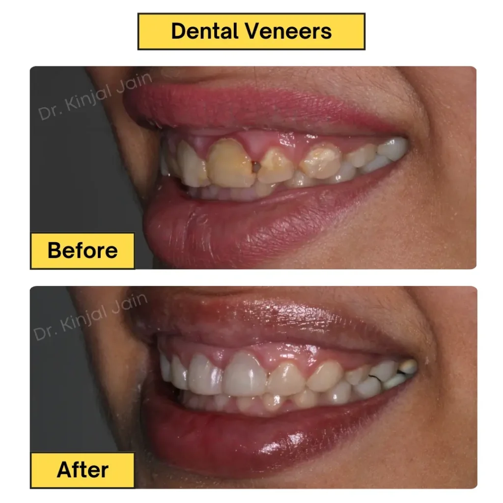 Composite Veneers