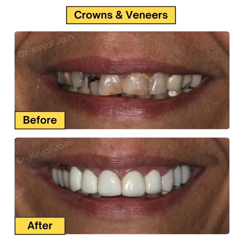 Crowns & Veneers