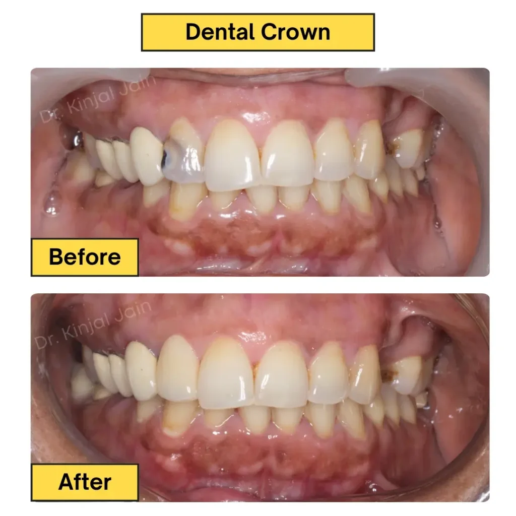 Dental Crown (1)