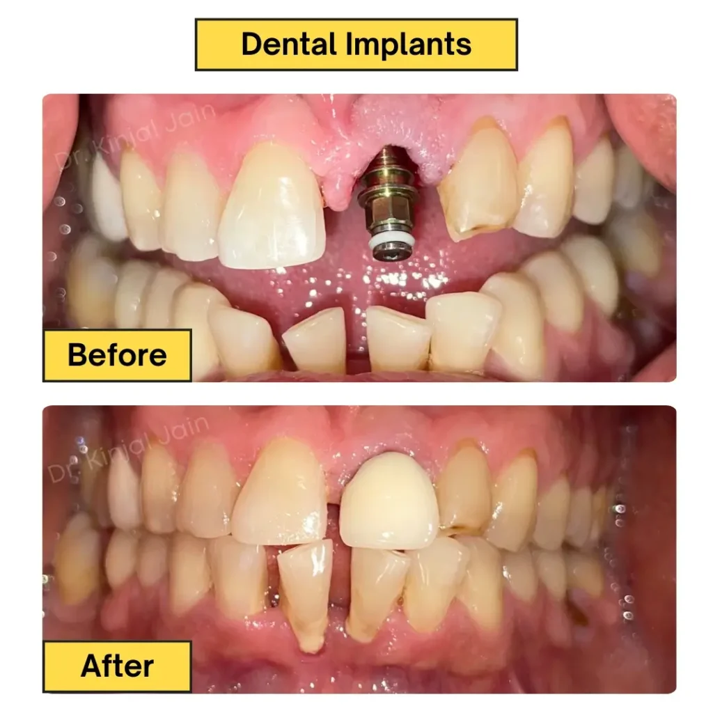 Dental Implants