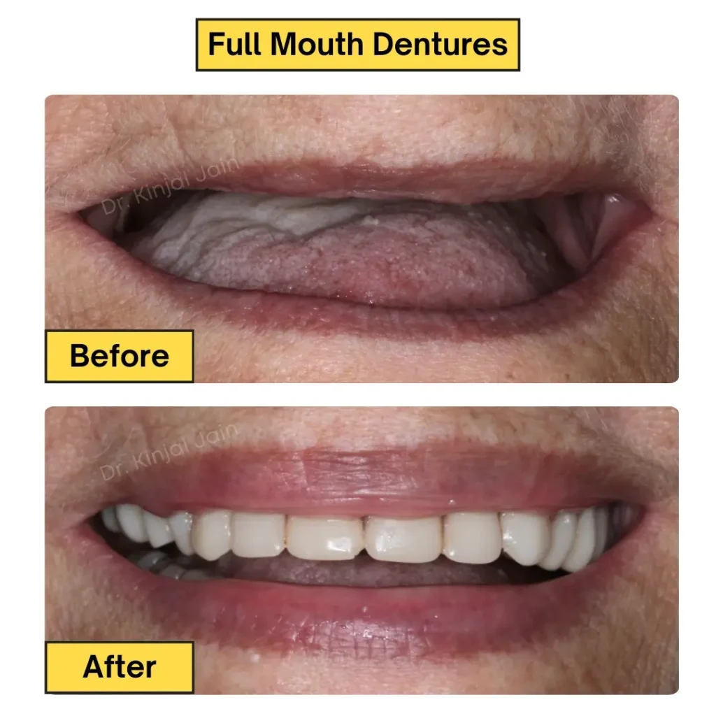 Full Dentures Result