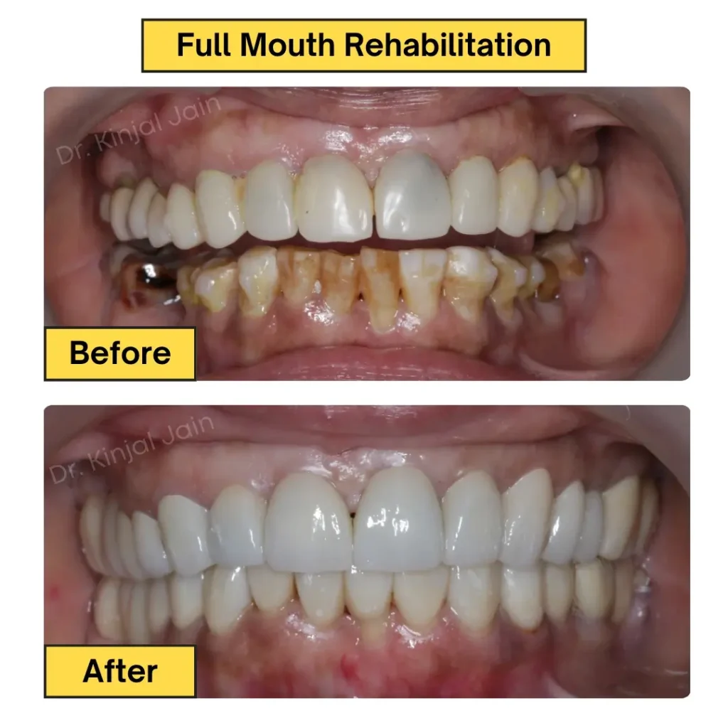 Full Mouth Rehabilitation
