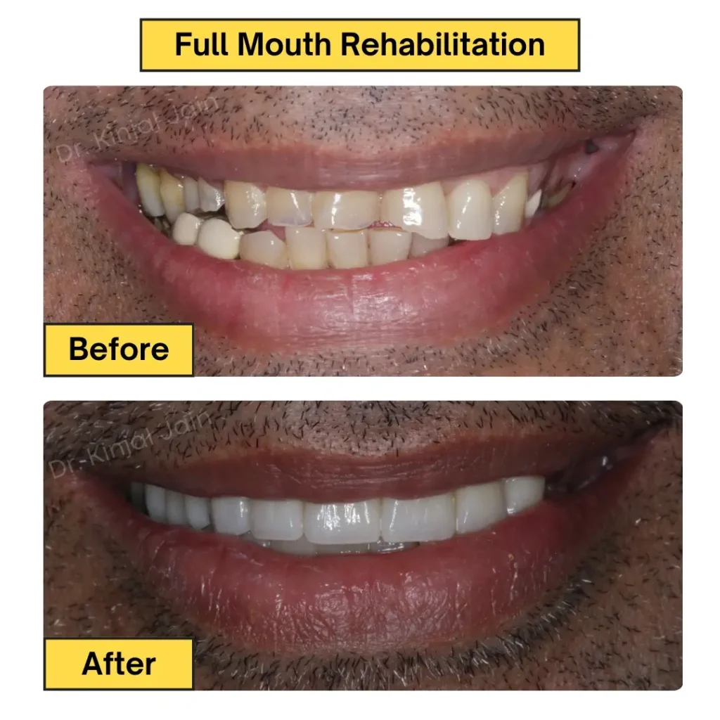 Full Mouth Rehabilitation (3)