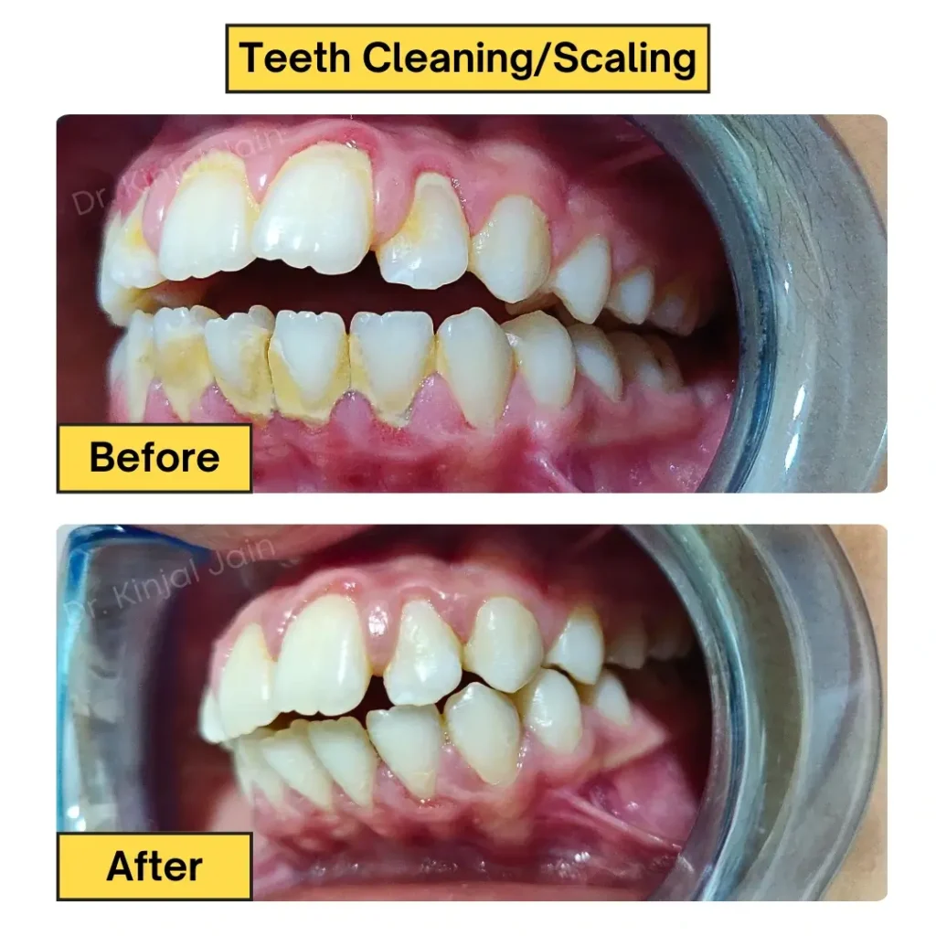 Teeth Cleaning_Scaling