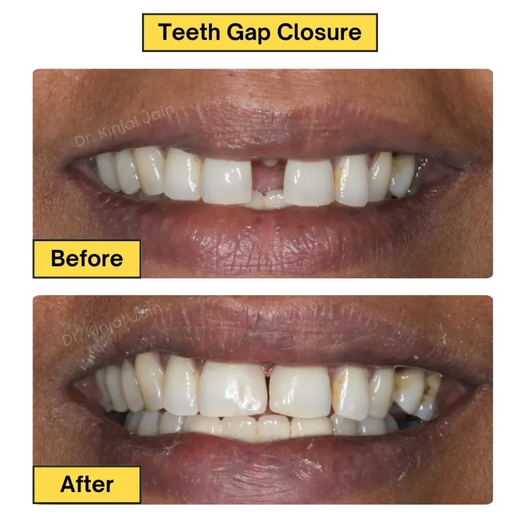 Teeth Closure Result