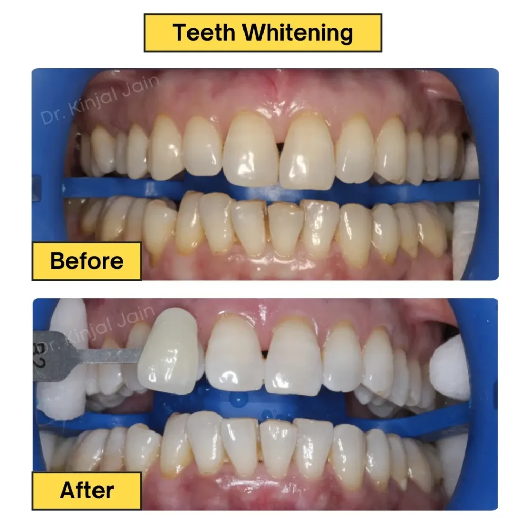 Teeth Whitening