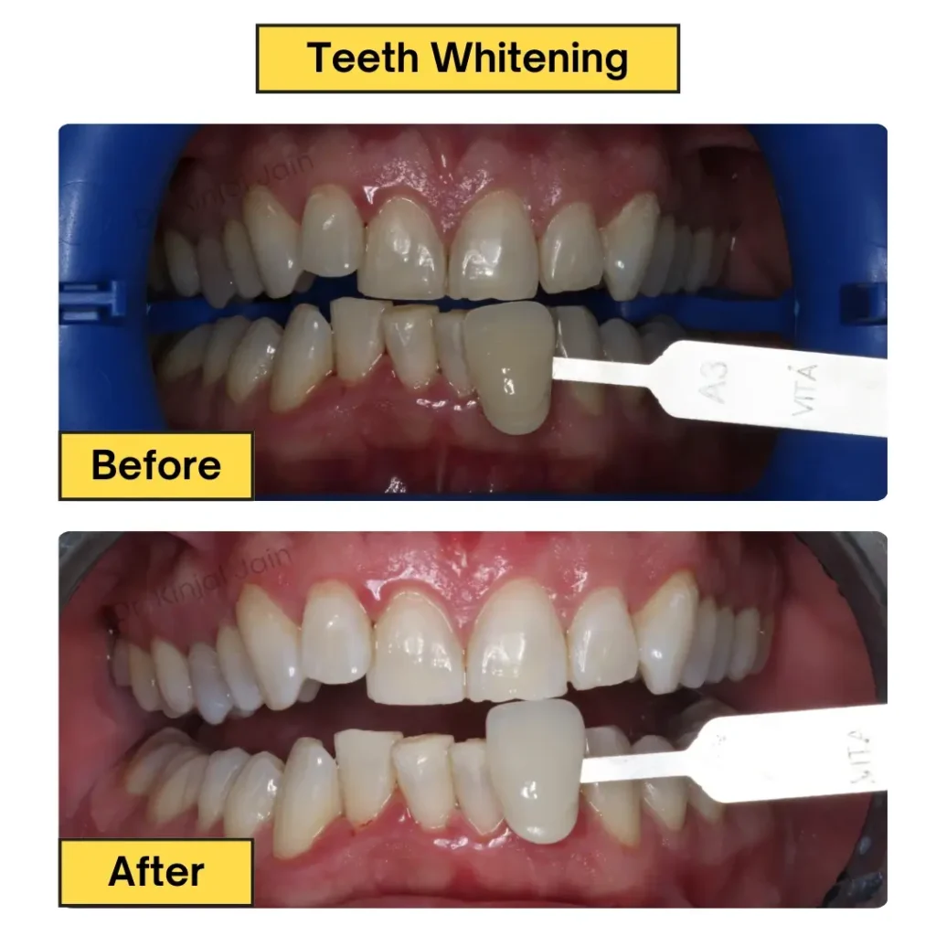 Teeth Whitening