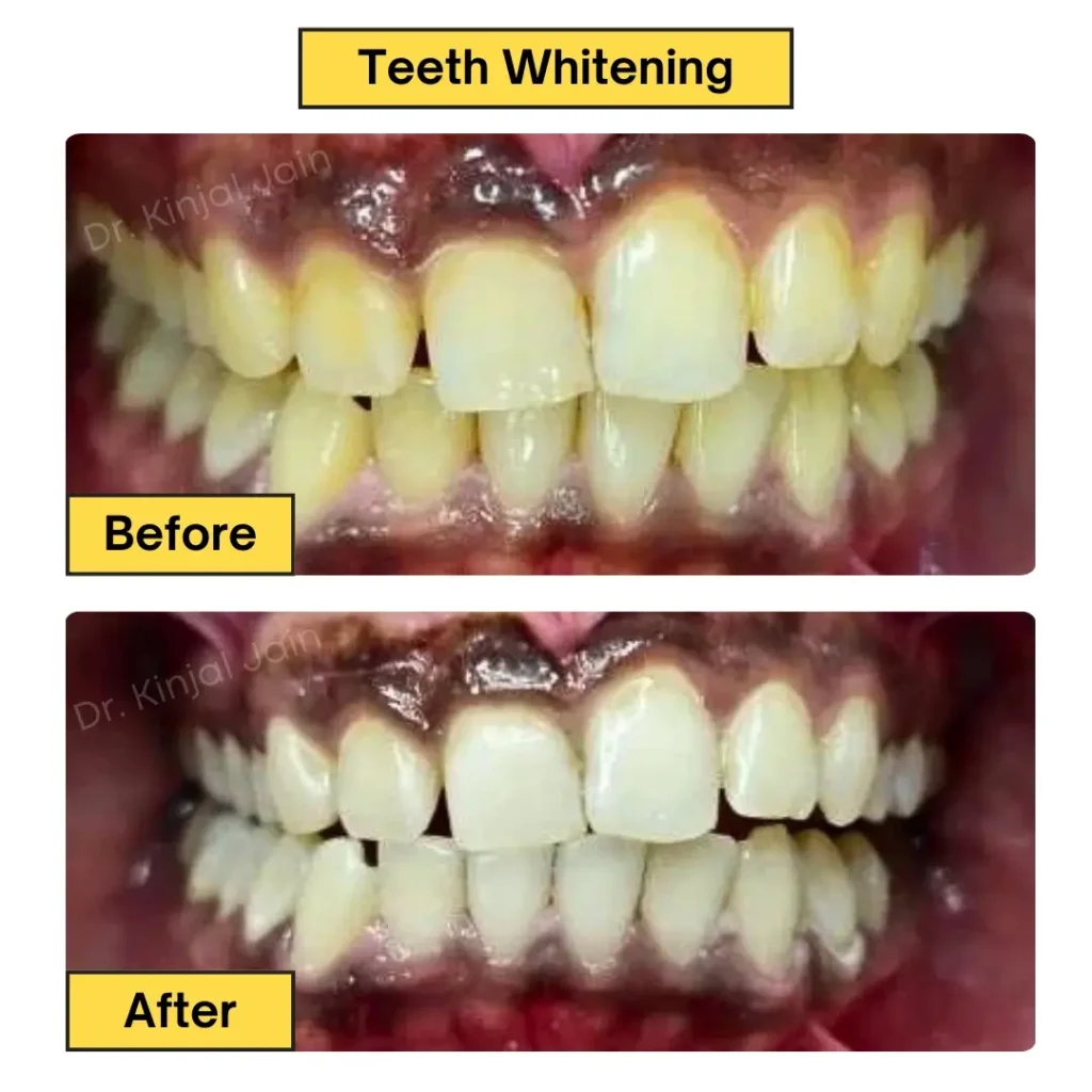 Teeth Whitening