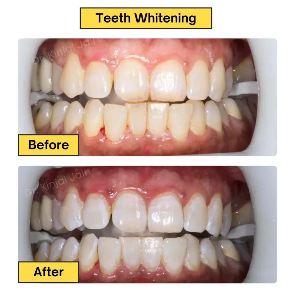 Teeth Whitening