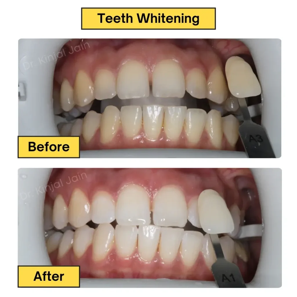 Teeth Whitening