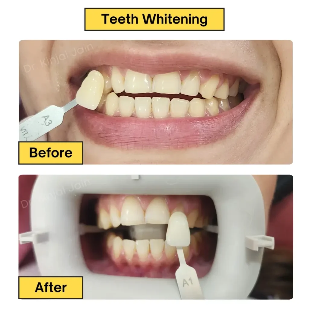 Teeth Whitening